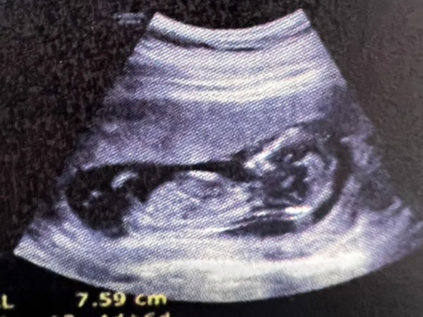 孕囊椭圆形竟然是男孩还是女孩